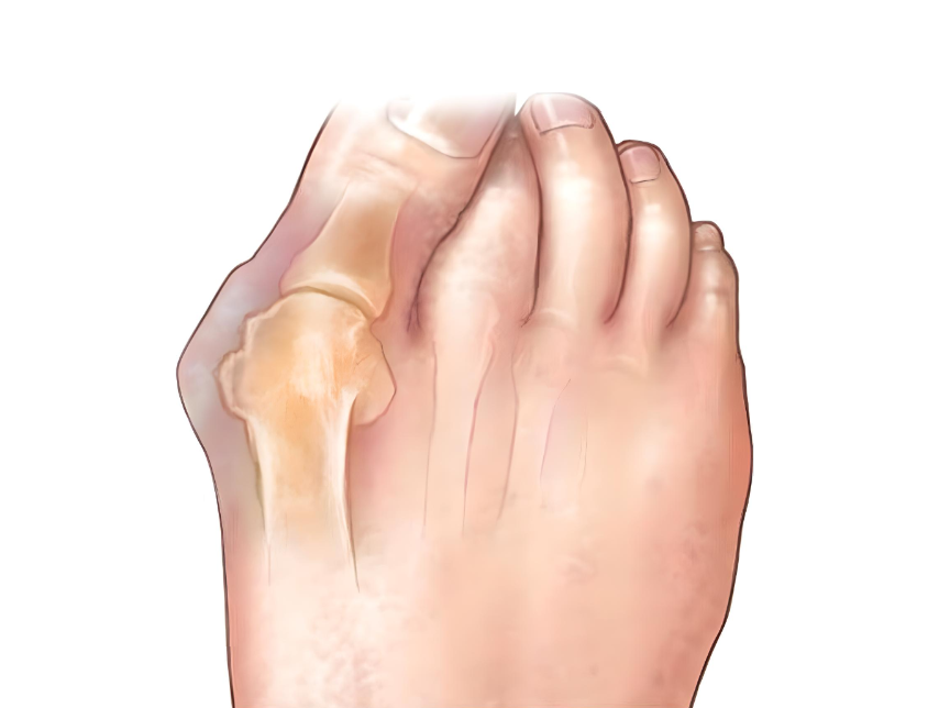 Bunion Exerciser Strap For Happier Feet