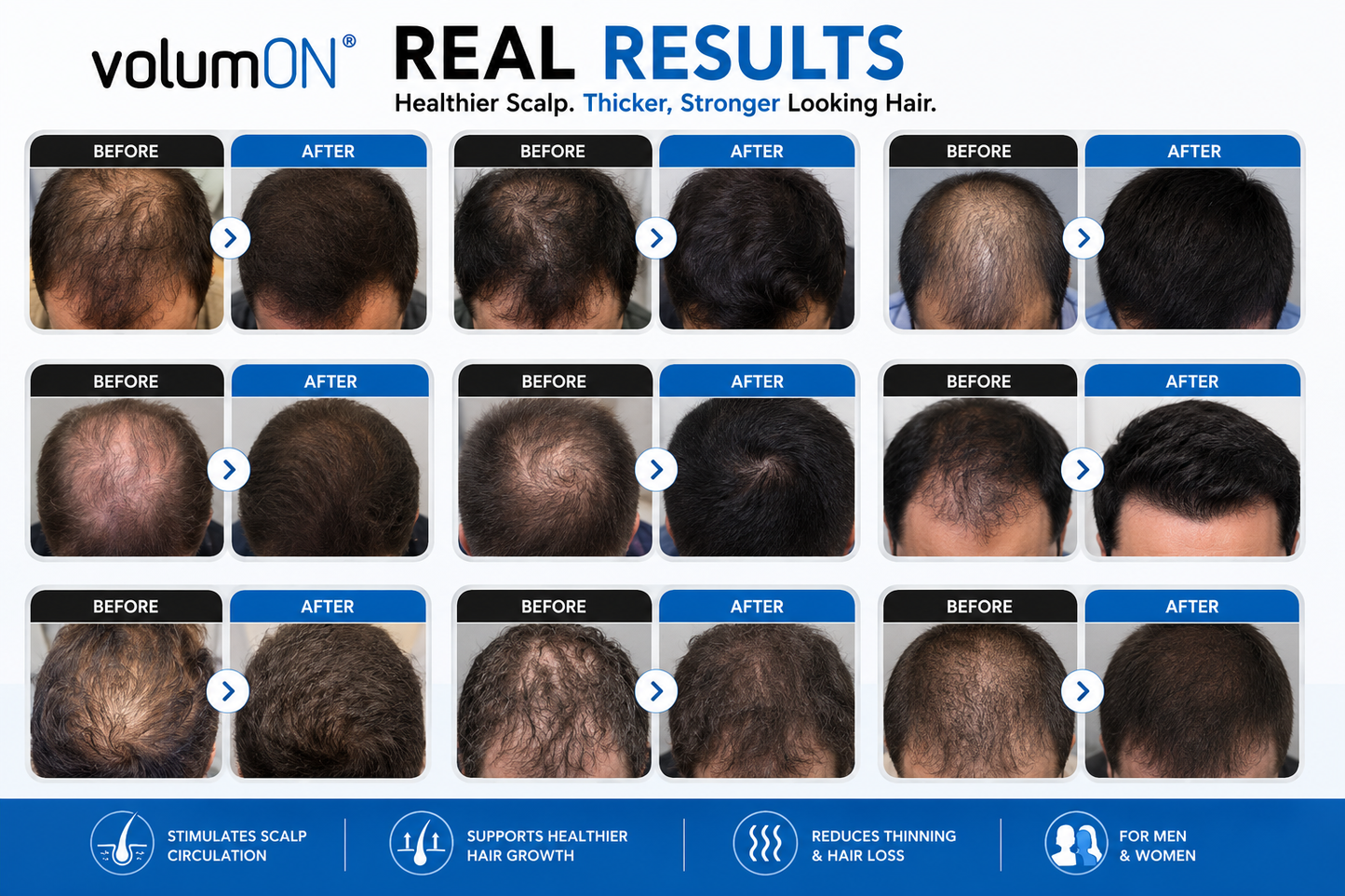 Volumon Laser Hair Massage Comb – Stimulate Hair Growth & Boost Scalp Health