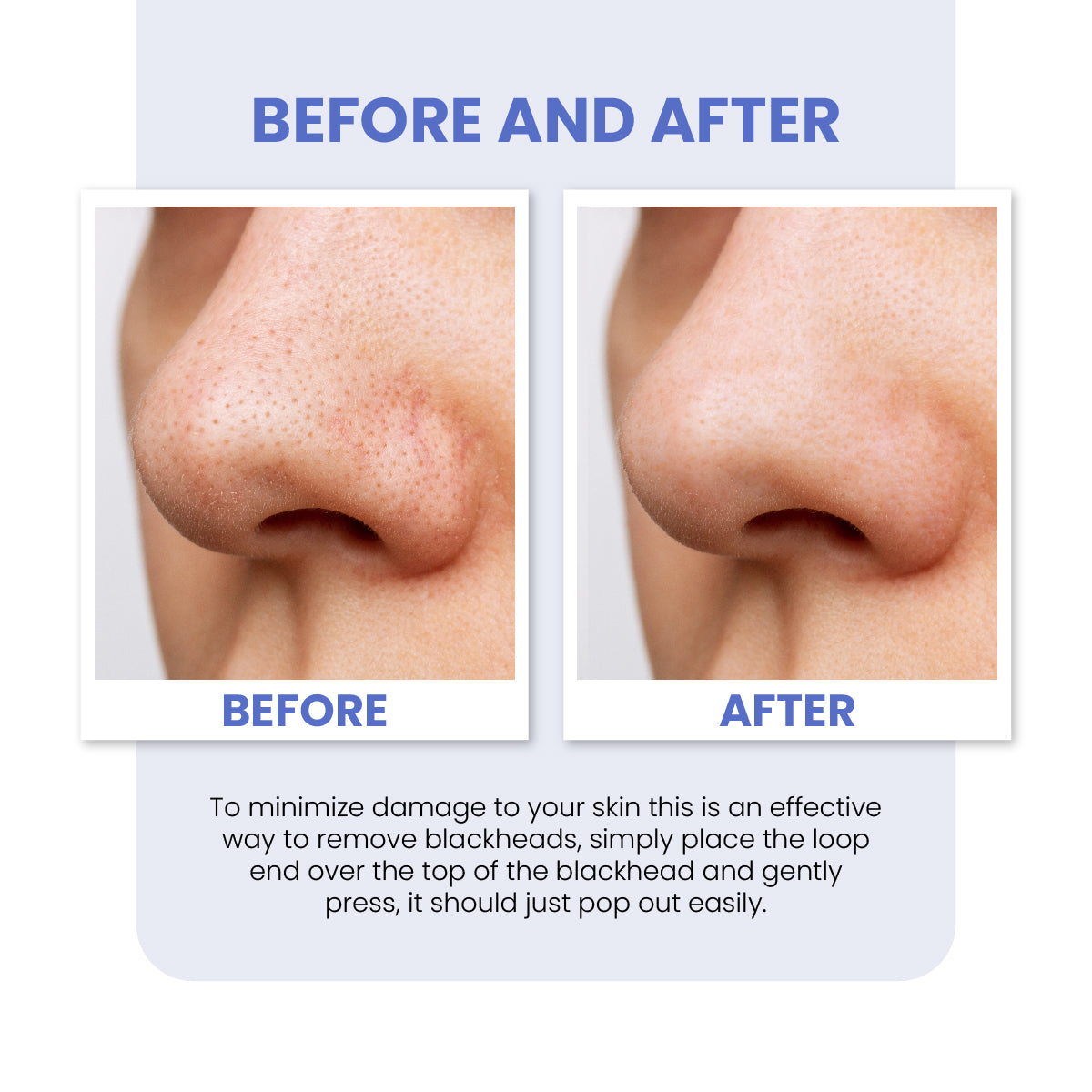 7pc Blackhead Pimple Tool Kit