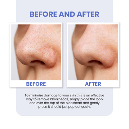 7pc Blackhead Pimple Tool Kit