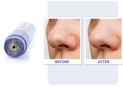 Electric Blackhead Remover & Pore Cleanser