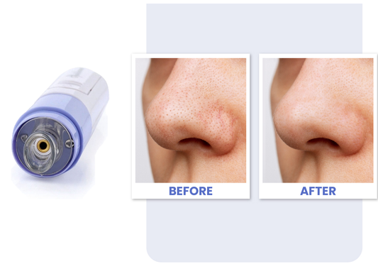 Electric Blackhead Remover & Pore Cleanser