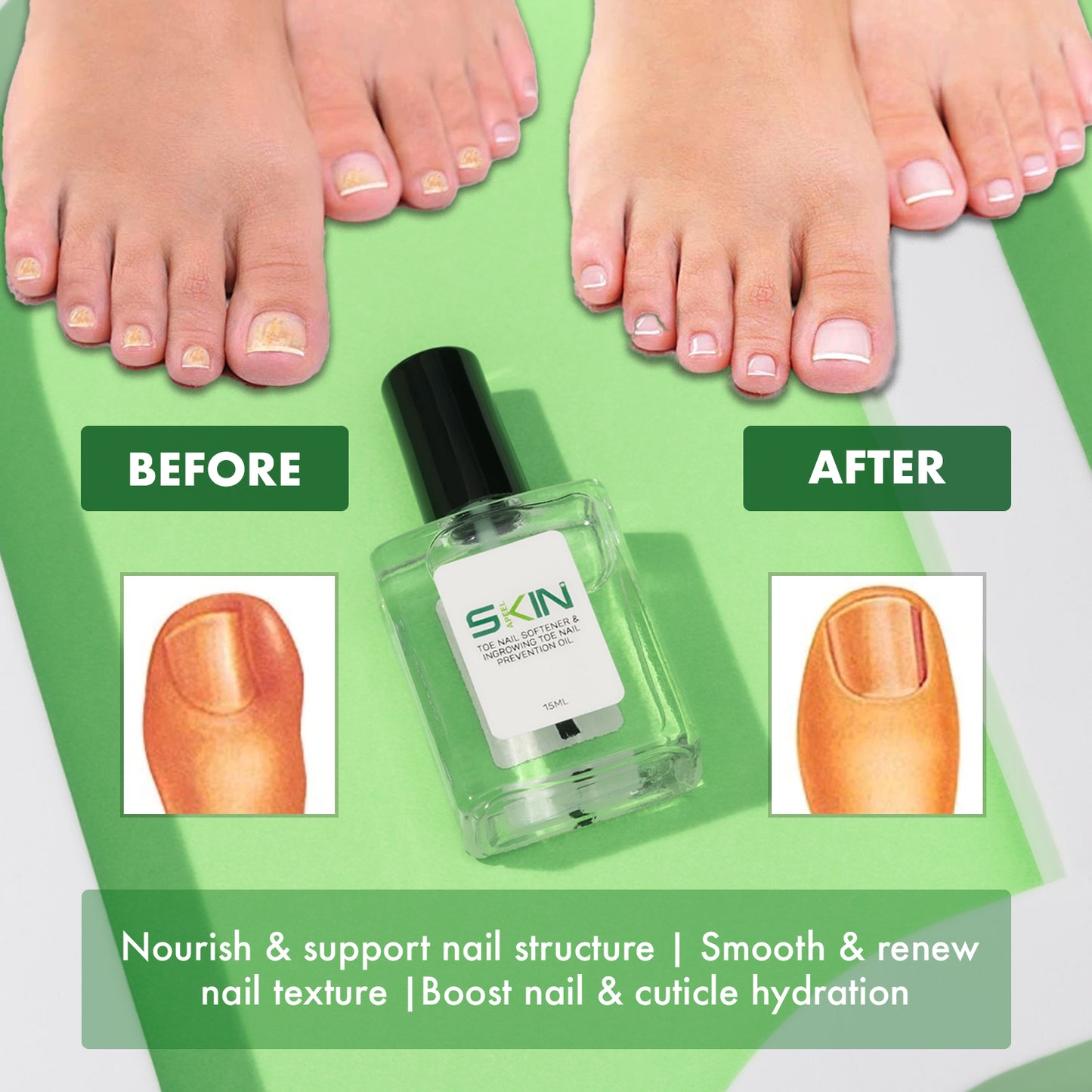 Skinapeel Toe Nail Softener and Ingrowing Toenail Prevention Oil 15ml