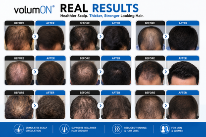 Volumon Laser Hair Massage Comb – Stimulate Hair Growth & Boost Scalp Health