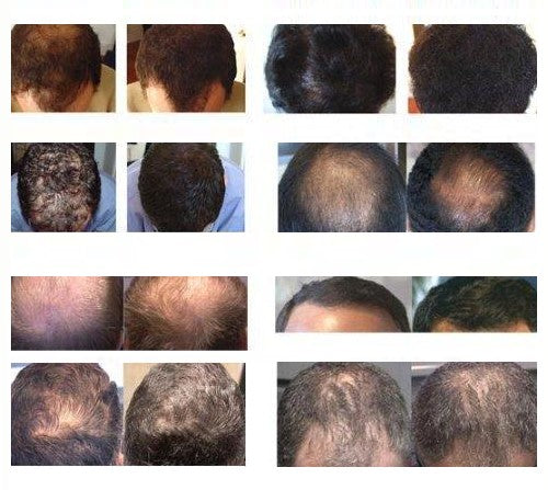 Volumon Hair Regrowth Solution Spray