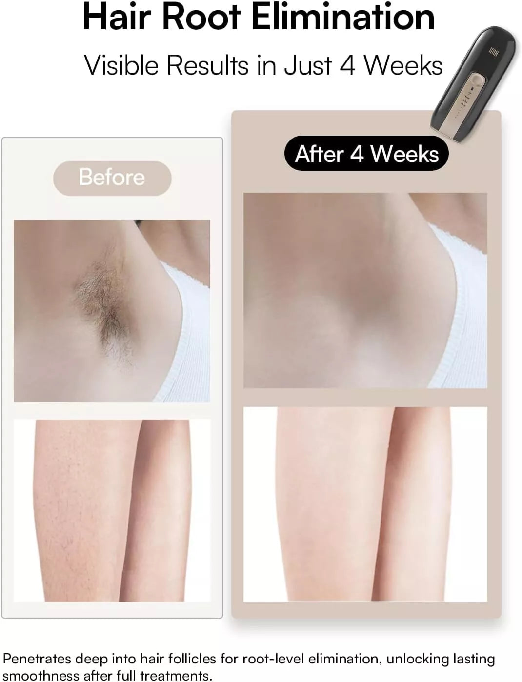 INIA Laser Hair Removal Device