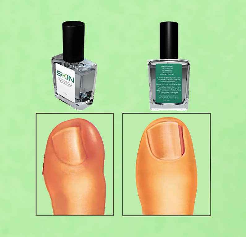 Skinapeel Toe Nail Softener and Ingrowing Toenail Prevention Oil 15ml