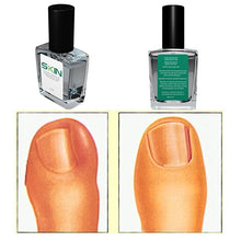 Load image into Gallery viewer, Skinapeel Toe Nail Softener and Ingrowing Toenail Prevention Oil