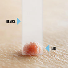 Load image into Gallery viewer, Tagcure PLUS - Skin Tag Removal Device