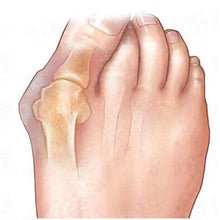 Load image into Gallery viewer, Generise Bunion Exerciser