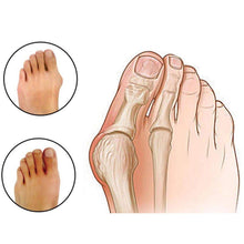 Load image into Gallery viewer, Glamza Splint Corrector Device - Pair