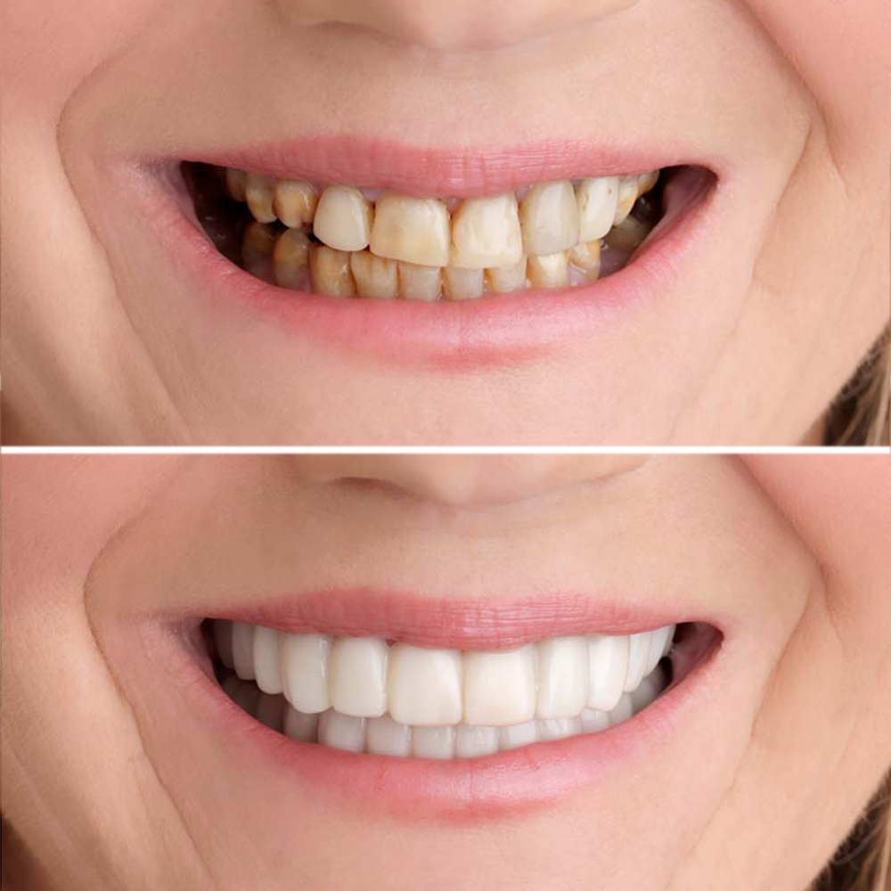 Glamza Get Set Smile Veneers