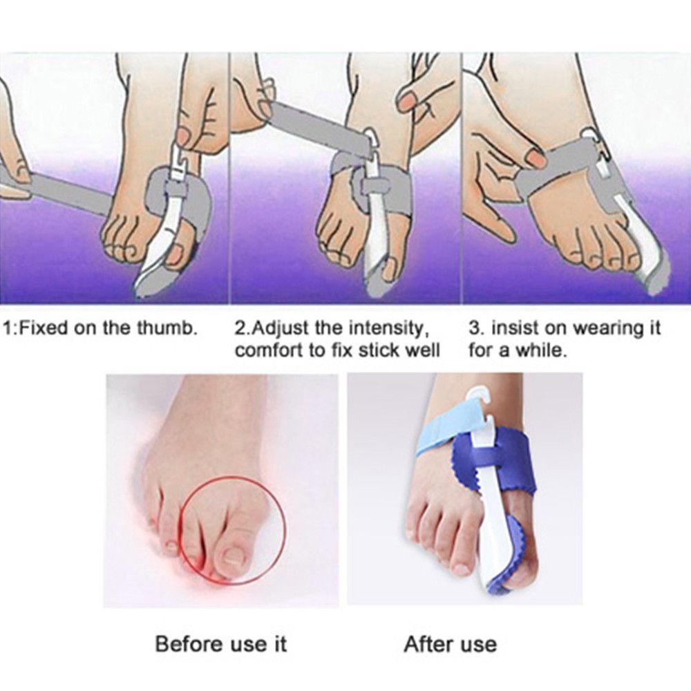 Glamza Splint Corrector Device - Pair