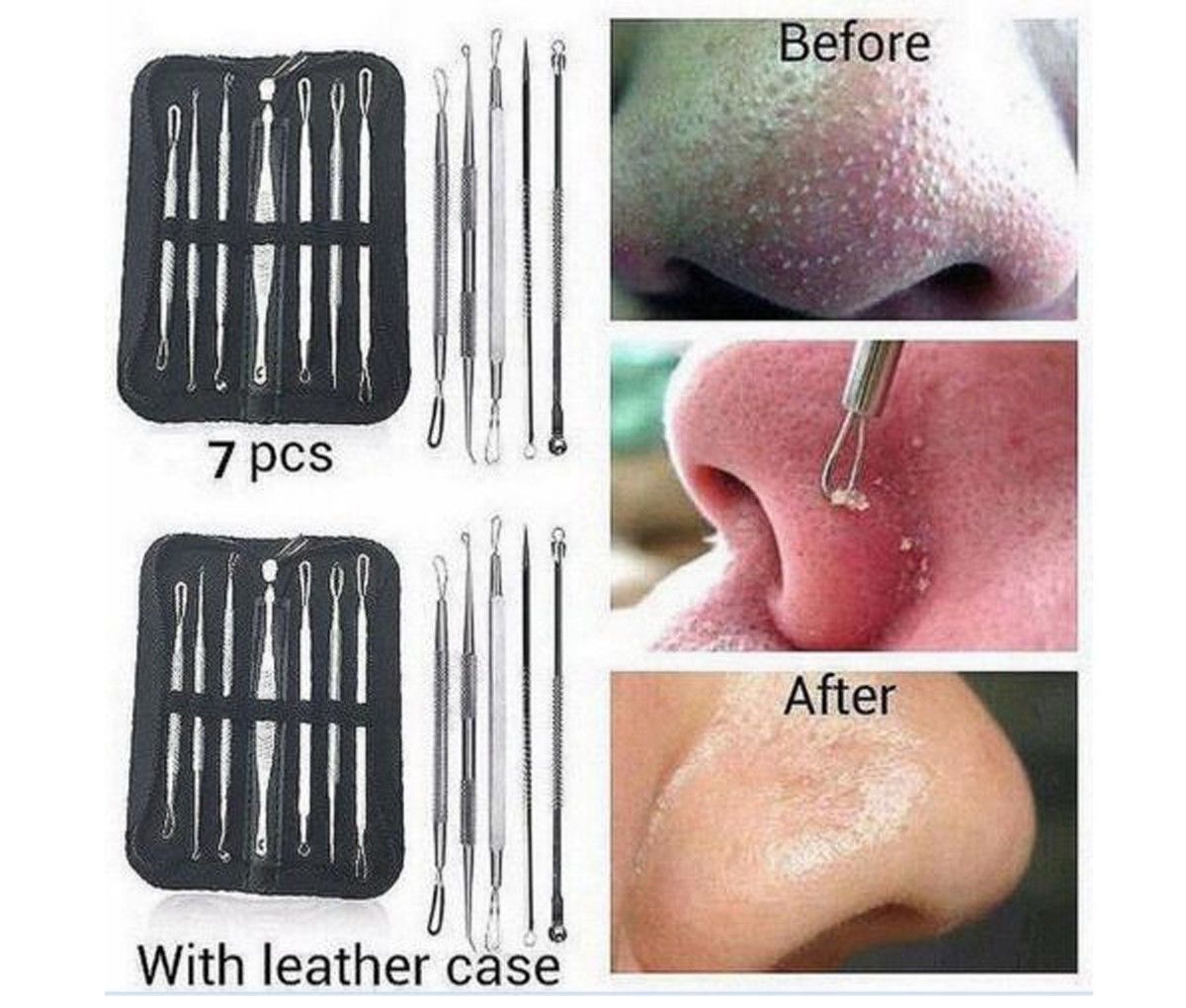 7pc Blackhead Pimple Tool Kit